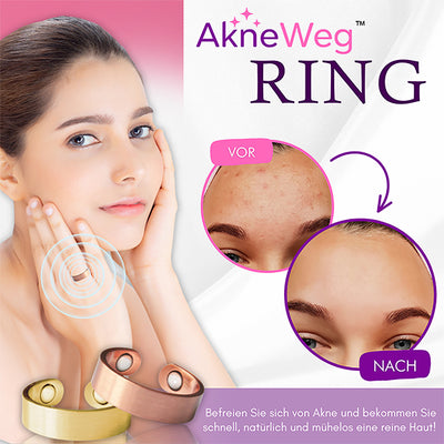 AkneWeg™ Ring
