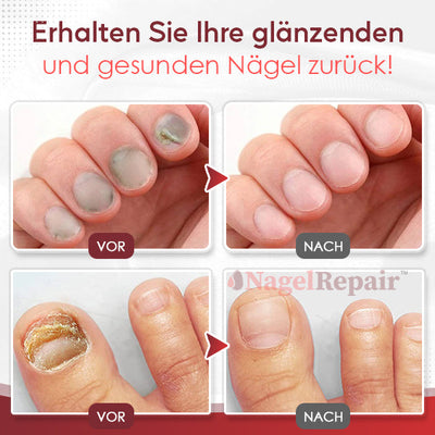 Wie wäre es mit 1 Packungen von NagelRepair™ Anti-Pilz-Nagellösung für NUR €9,99?
