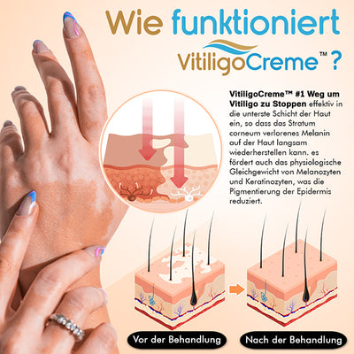 Erhalten Sie sich 2 Packungen des VitiligoCreme™ #1 Weg um Vitiligo zu Stoppen mit 75% Rabatt!