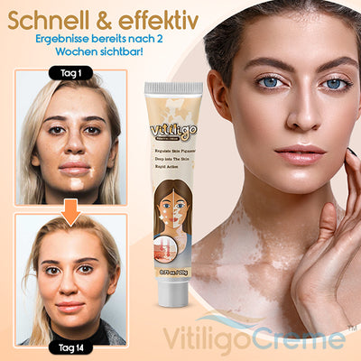 Wie wäre es mit 1 Packung des VitiligoCreme™ #1 Weg um Vitiligo zu Stoppen für NUR €9,99?