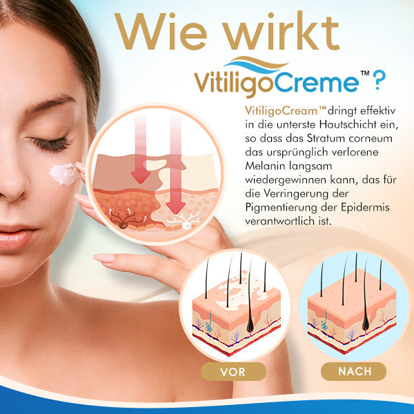 Erhalten Sie 2 Packungen von VitiligoCreme™ Der natürlichste Weg zur Behandlung von Vitiligo mit 75% Rabatt!